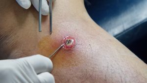 Apse İçin Diyet Listesi