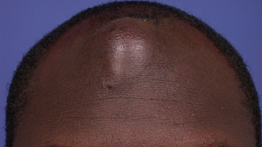 Apseye İyi Gelen Akapunktur Noktaları