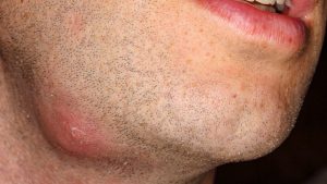 Çıban hangi hastalığın belirtisidir?