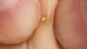 Çıbana İyi Gelen Bitkisel Çaylar