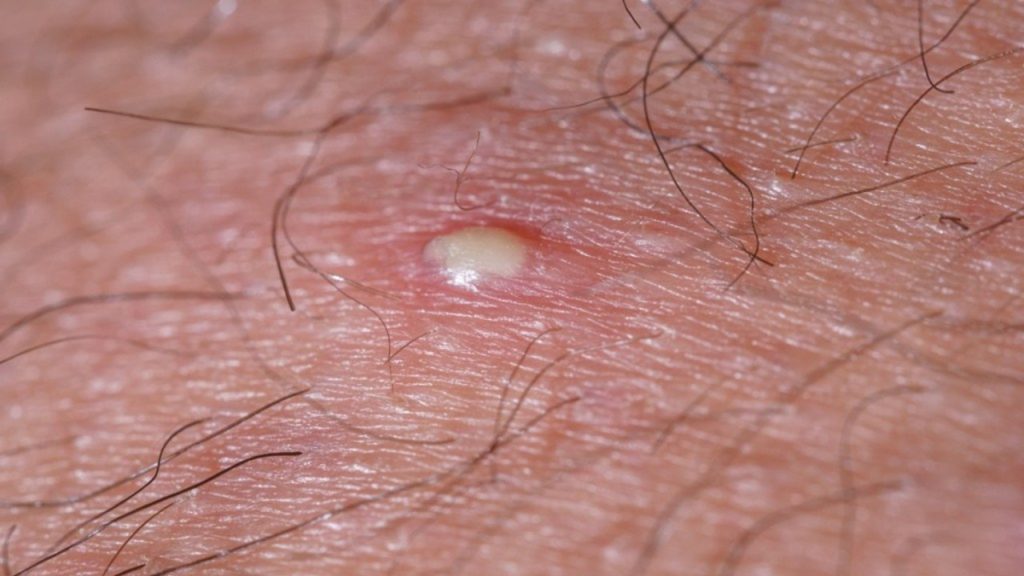 Çıbana İyi Gelen Doğal Maskeler