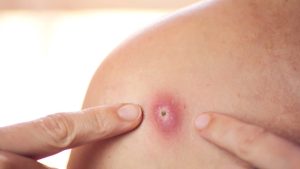 Çıbana İyi Gelen Şifalı Yağlar