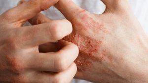 Deride görülen her çeşit iltihaplı hastalık