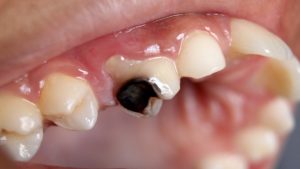Şekerli ve unlu ürünlerin fazla tüketilmesi sonucu oluşan dental problem hangisidir?