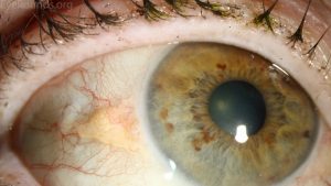 Aşağıdakilerden hangisi damar tabakanın elemanı değildir?