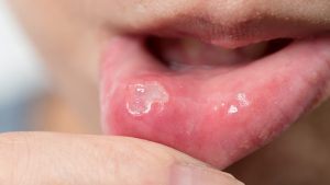 Ağız ve Dil İltihabı İlaçları