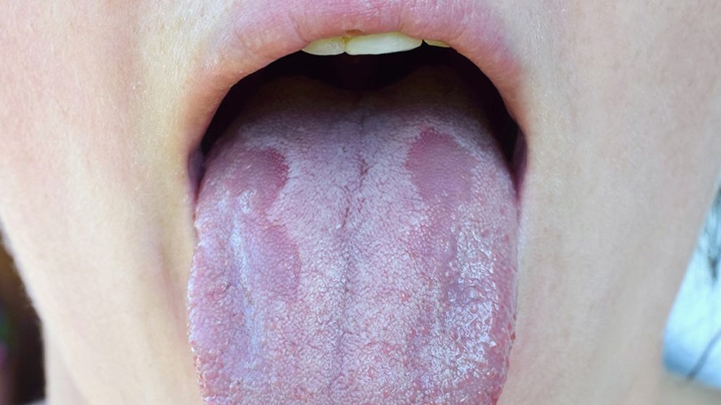 Ağız ve Dil İltihabına İyi Gelen Bitkisel Banyolar