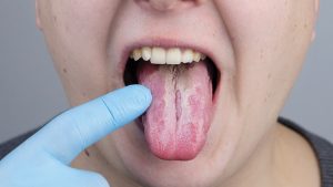 Ağız ve Dil İltihabına İyi Gelen Bitkisel Kremler