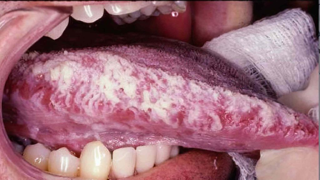 Ağız ve Dil İltihabına İyi Gelen Şifalı Taşlar