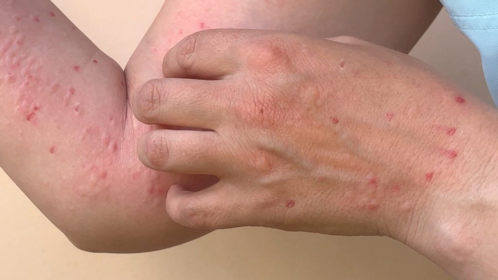 Maymun Çiçeği Virüsü İlaçları