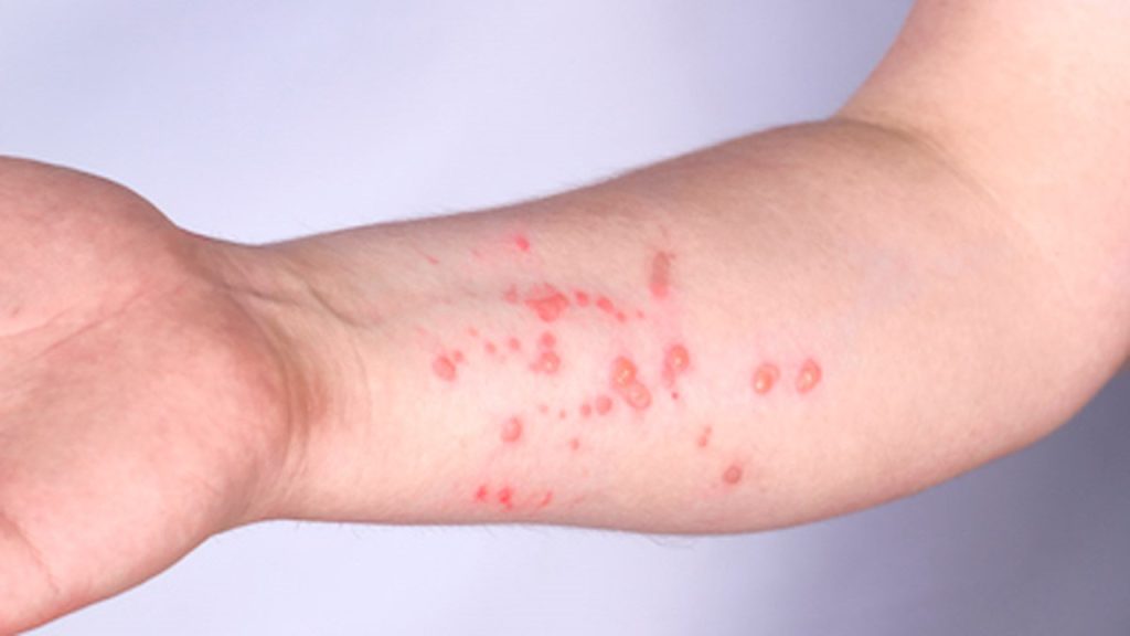 Maymun Çiçeği Virüsü Sebepleri, Belirtileri ve Tedavisi