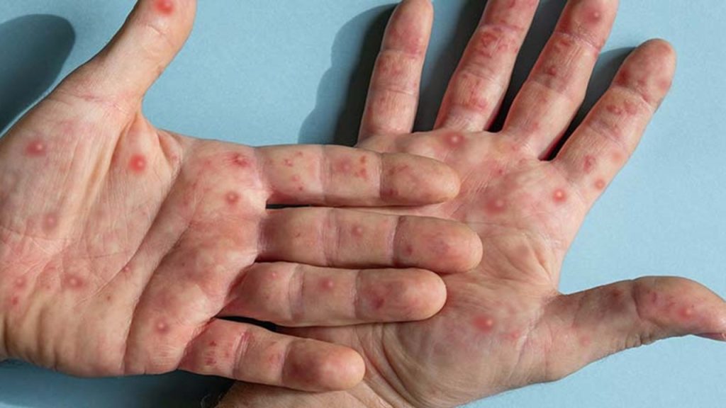 Maymun Çiçeği Virüsüne İyi Gelen Bitkisel Kremler