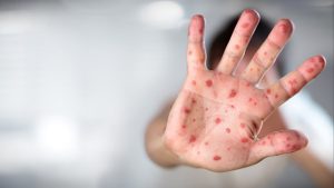 Maymun çiçeği hastalığına ne iyi gelir?