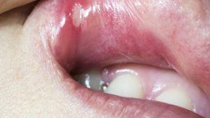 Ağız Kabarcıklarına İyi Gelen Bitkisel Çaylar