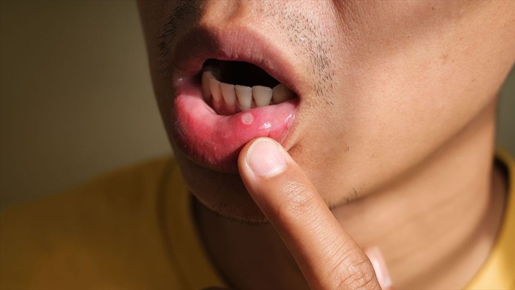 Ağız Kabarcıklarına İyi Gelen Hacamat Noktaları