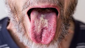 Ağız Mantarına İyi Gelen Bitkisel İlaçlar