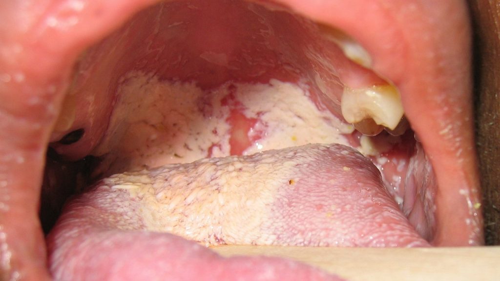 Ağız Mantarına İyi Gelen Şifalı Taşlar