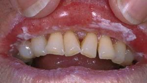 Ağız Mantarına İyi Gelen Şifalı Yağlar