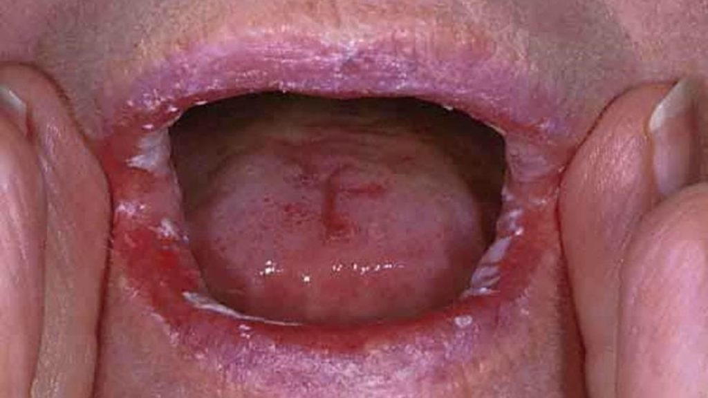 Ağız Mantarına İyi Gelen Yiyecekler ve İçecekler