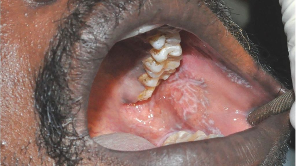 Ağız Yanmasına İyi Gelen Bitkisel Kremler