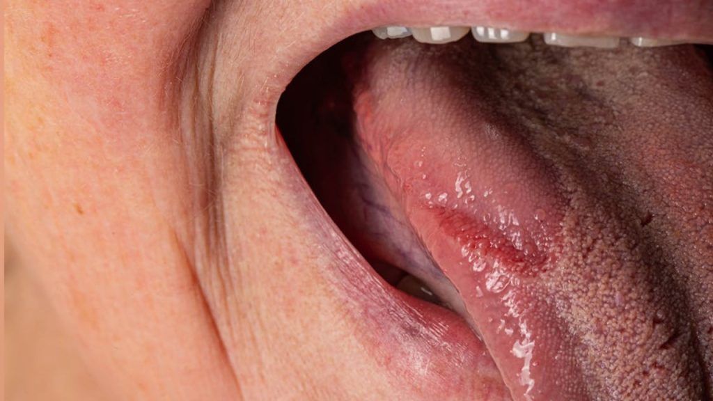 Ağız Yanmasına İyi Gelen Doğal Maskeler