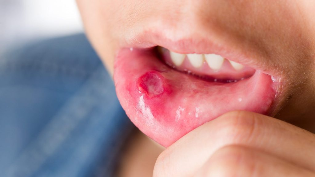 Ağız Yarasına İyi Gelen Bitkisel Kremler