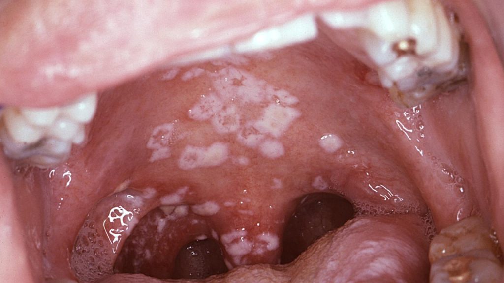 Ağız mantarı nasıl geçer?