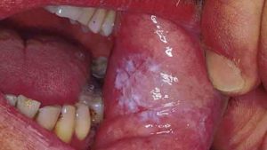 Ağız mantarına ne iyi gelir?