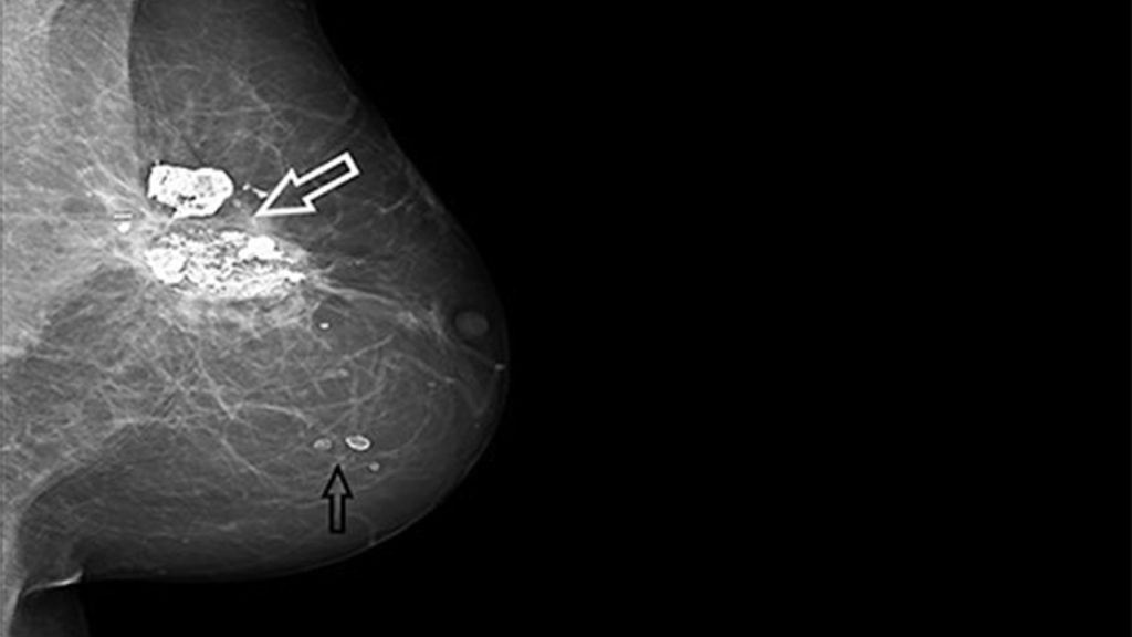 Memede travmatik yağ nekrozu