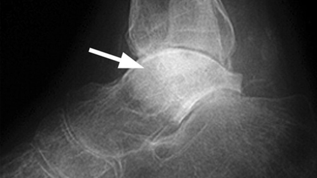 Talus Avasküler Nekrozu