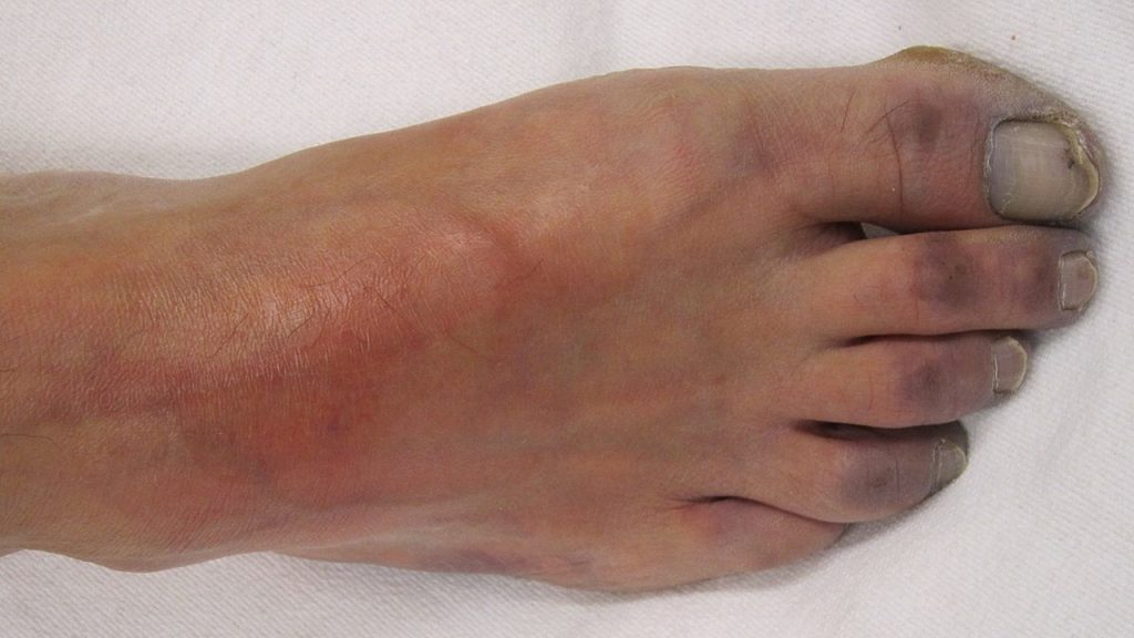 Bir dokunun kanlanmasındaki azalmaya ne ad verilir?