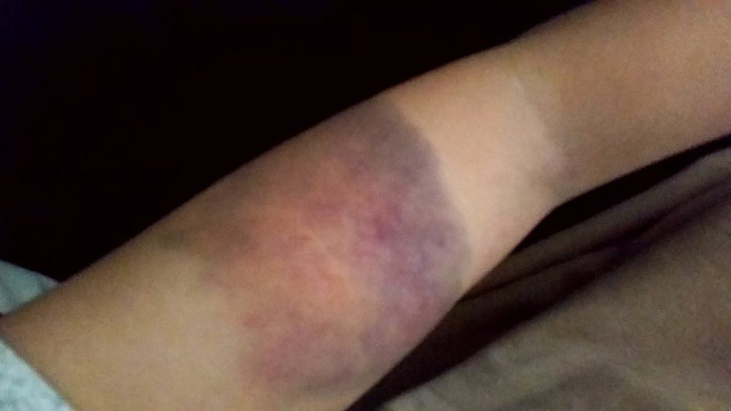 Bu vakada hastanın kolundaki hematom göz önüne alındığında aşağıdaki damarlardan hangisinde bir kanama olasılığı en yüksektir?