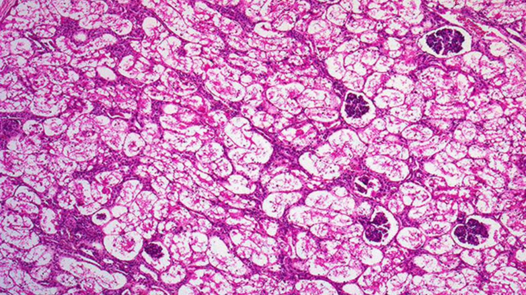 İskemik hücre nekrozunun ışık mikroskopundaki en erken bulgusu nedir?