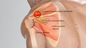 Klavikulanın orta 1/3’lük kısmının kırıklarında aşağıdaki sinirlerin hangisinde zedelenme görülür?