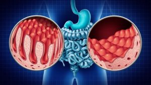 Çölyak hastalarının beslenme hakkını korumak amacıyla ekonomik durumu yetersiz olan kişilere aylık olarak glutensiz temel gıda paketi sağlanması veya nakdi sosyal destek ödemesi yapılması haberi