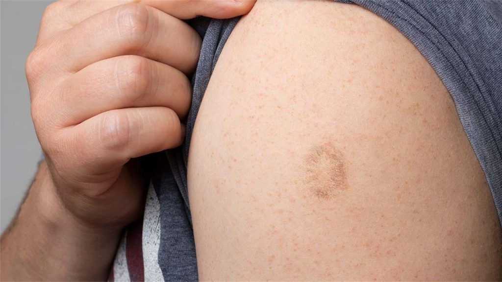 İlk başarılı aşılama hangisidir?