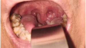 Bademcik Kanseri Belirtileri