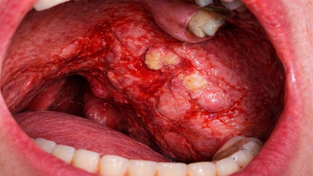 Bademcik Kanseri Bitkisel Çözüm