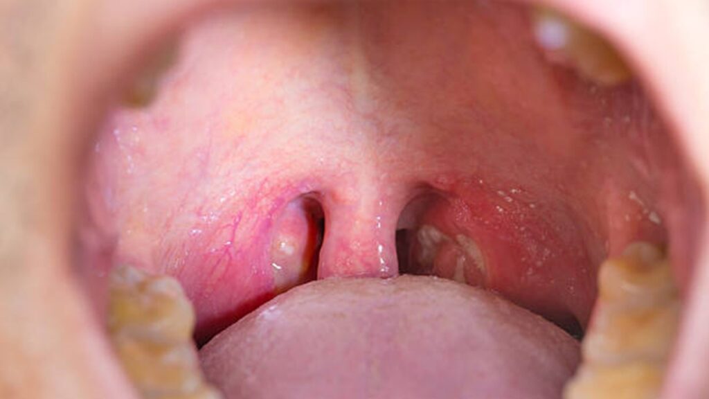 Bademcik Şişmesi Belirtileri