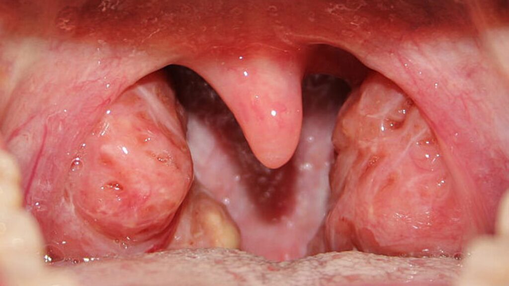 Bademcik iltihabı belirtileri