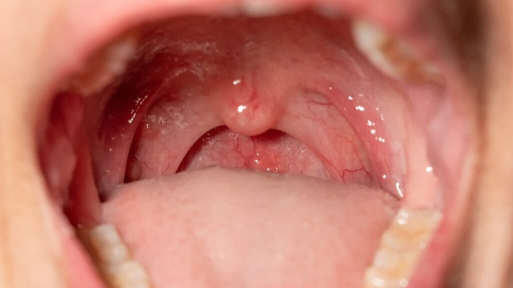 Bademcik neden şişer?