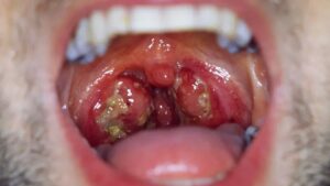 Bademcik şişmesi kaç günde geçer?