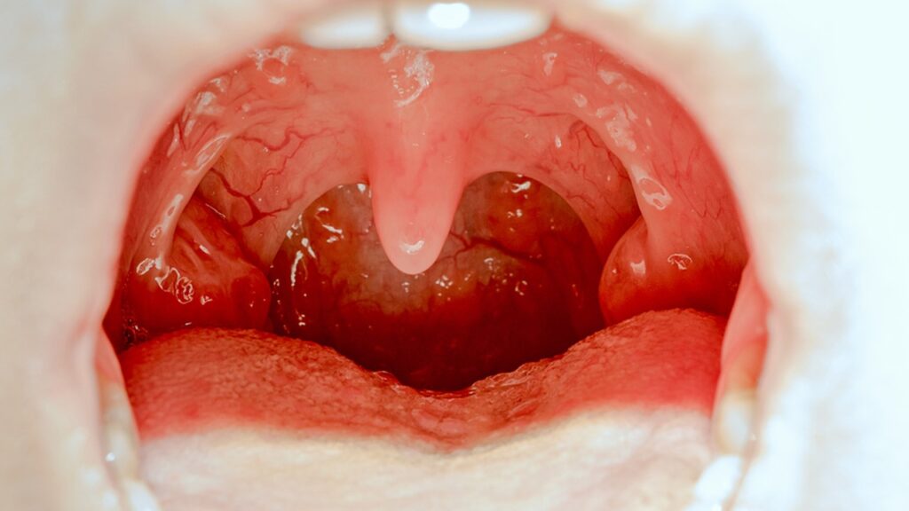 Bademcik şişmesi nasıl olur?