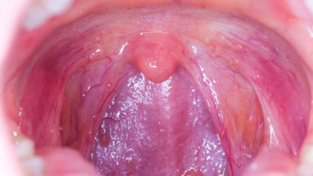 Bademcik şişmesine ne iyi gelir?