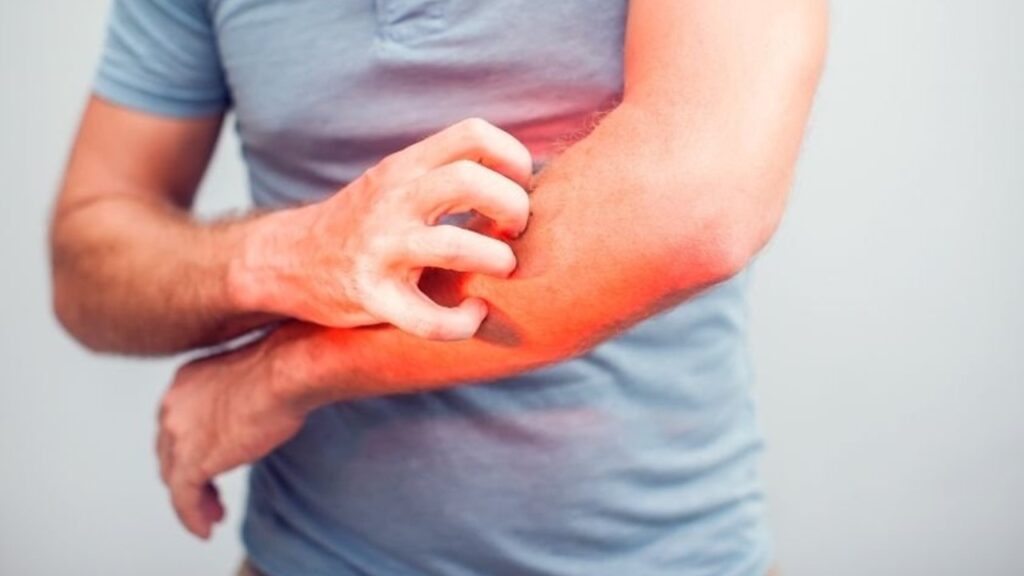 Kaşıntı Nedir? Nedenleri, Belirtileri ve Tedavisi