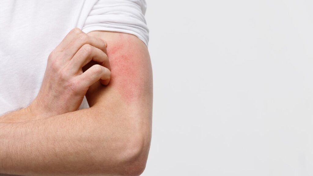 Kaşıntıya İyi Gelen Bitkisel Banyolar