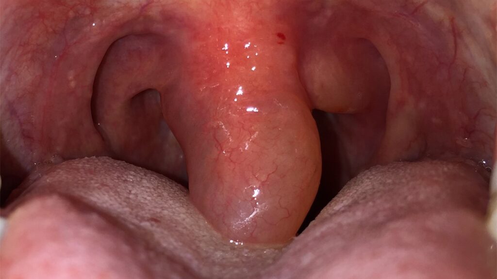 Küçük Dil Şişmesi