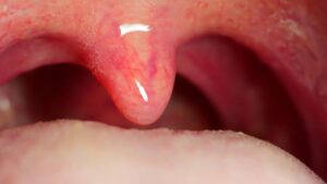 Küçük dilin tıptaki adı