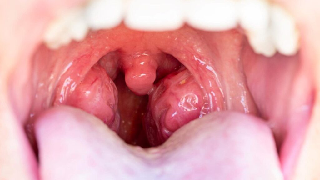 Tek taraflı bademcik şişmesi