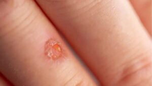 Wound, anagram of insole